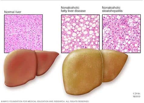 comparação patológica entre fígado normal e fígado gorduroso ou esteatose hepática